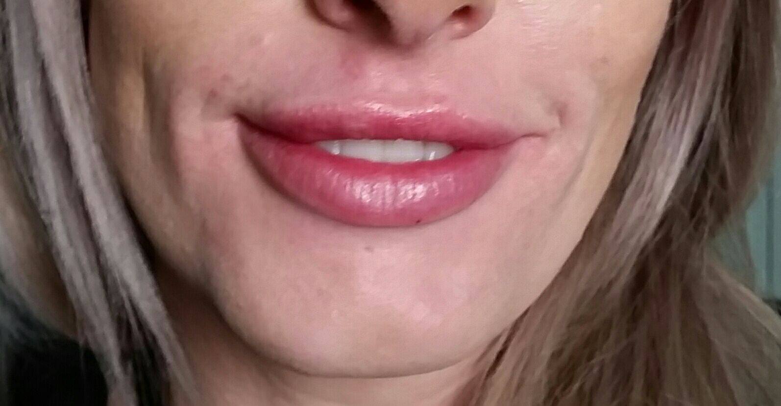 Teoxane Fillers - Derma Visage