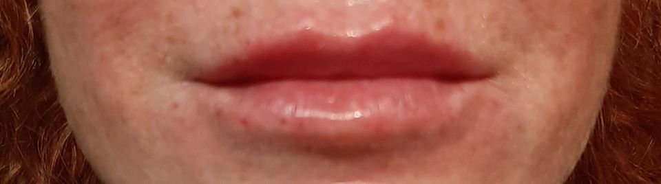 Before and After Derma Visage Lip Fillers