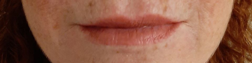 Before and after Derma Visage Lip Fillers