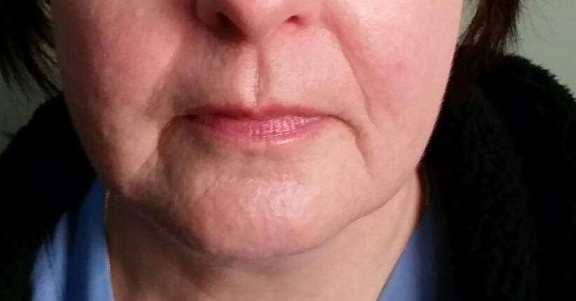 Teoxane Fillers - Derma Visage